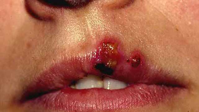 Stomatitis-Information 