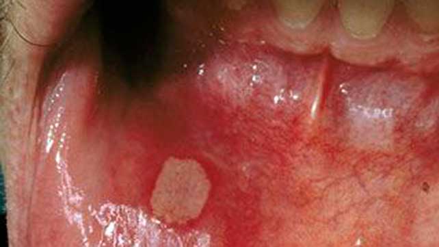 Stomatitis-Information 